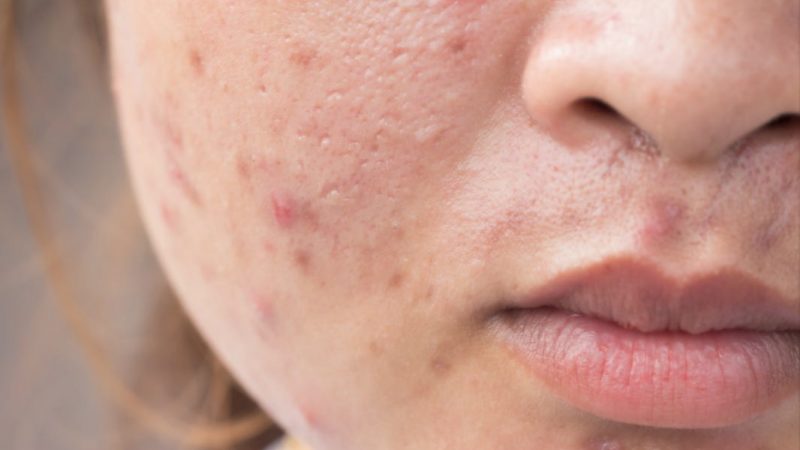 Yes, pregnancy can cause acne. Here’s when you will breakout the worst and how to treat it.