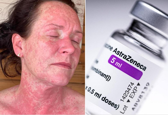 Woman suffers agonizing rash after Oxford-AstraZeneca COVID vaccine